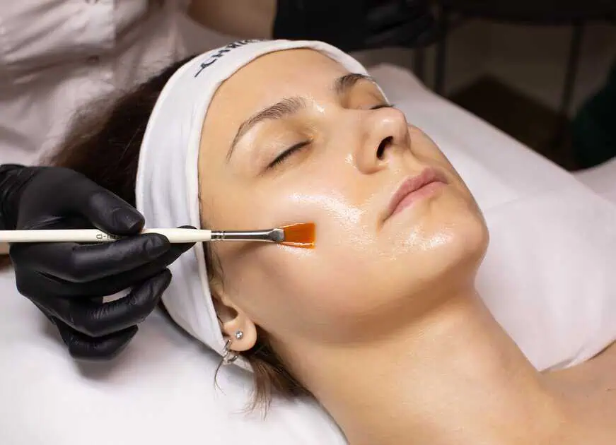 Chemical Peel Treatment in Roy, UT by Lunar Beauty and Wellness